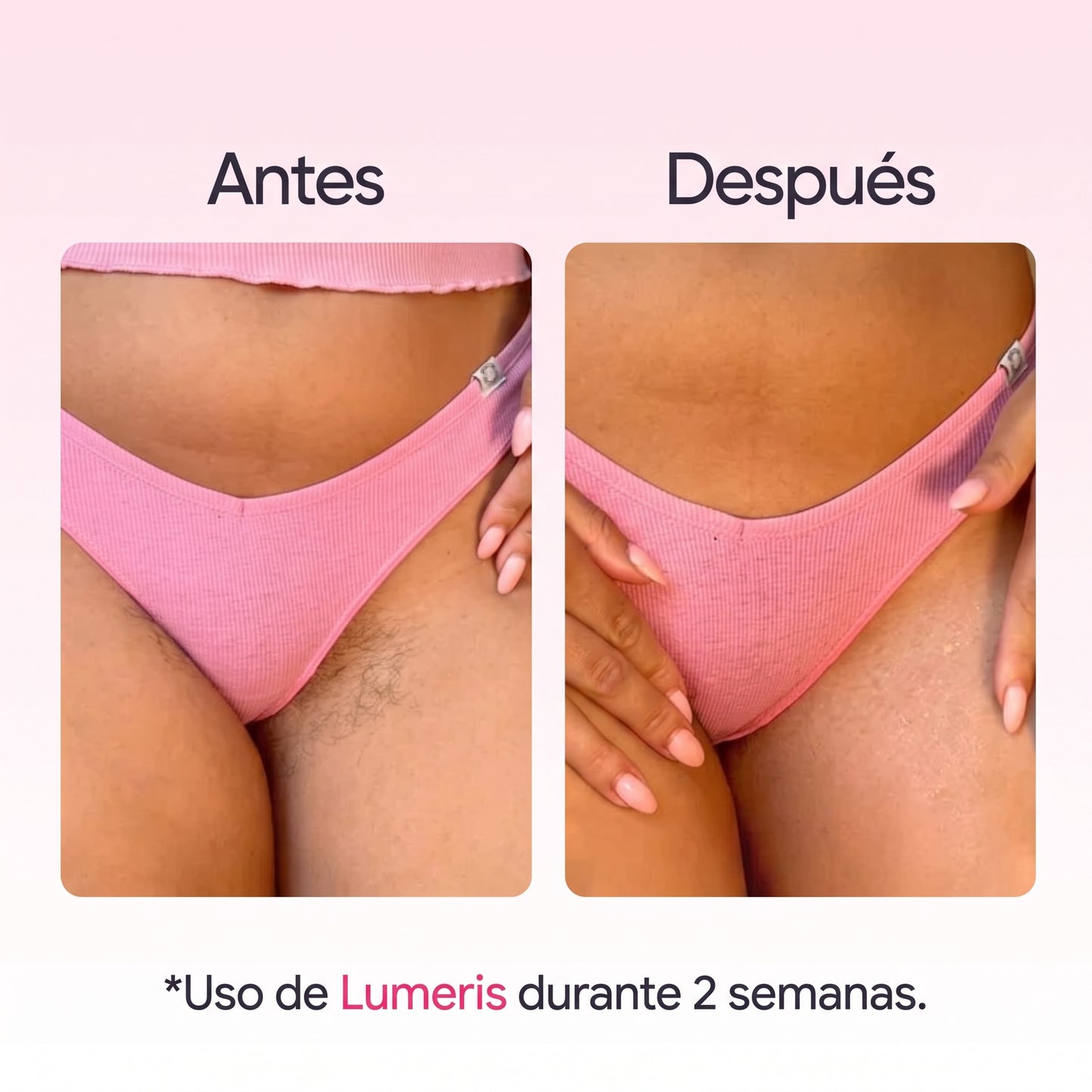 Lumeris® | Depilación láser permanente desde casa