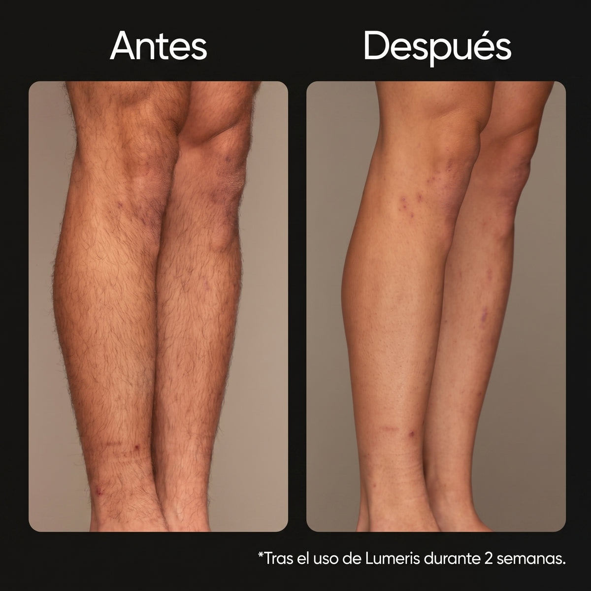 Lumeris® | Depilación láser permanente desde casa