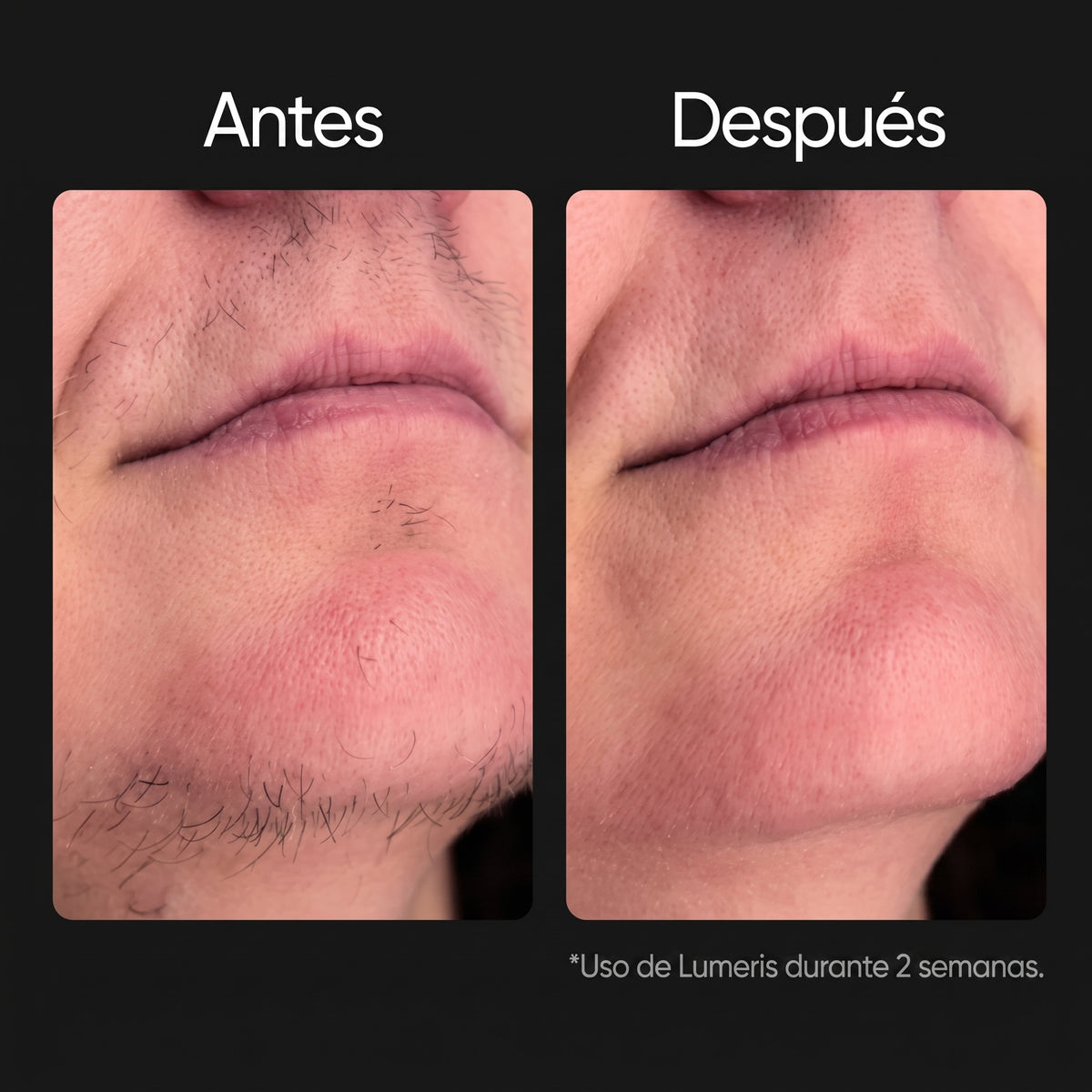 Lumeris® | Depilación láser permanente desde casa