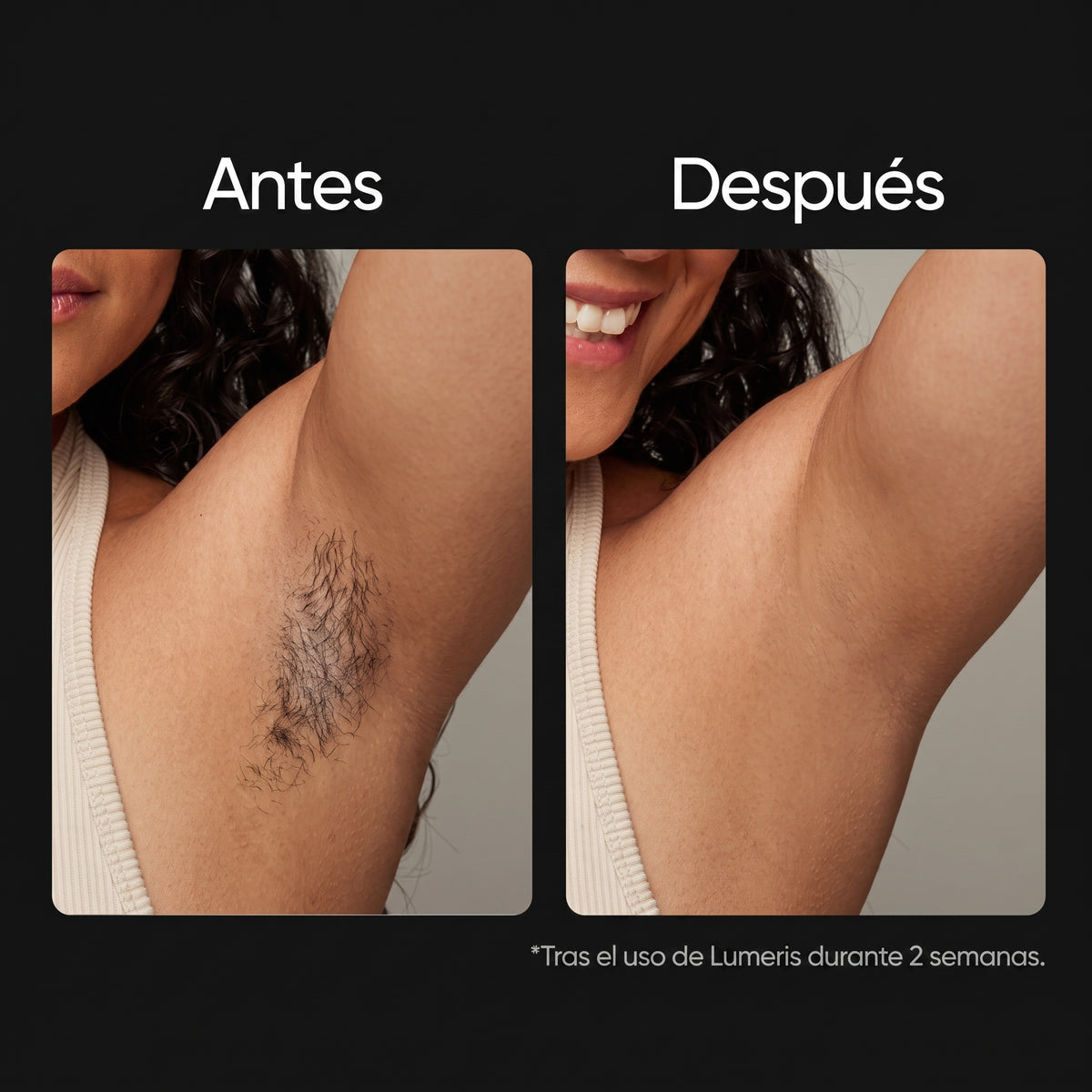 Lumeris® | Depilación láser permanente desde casa
