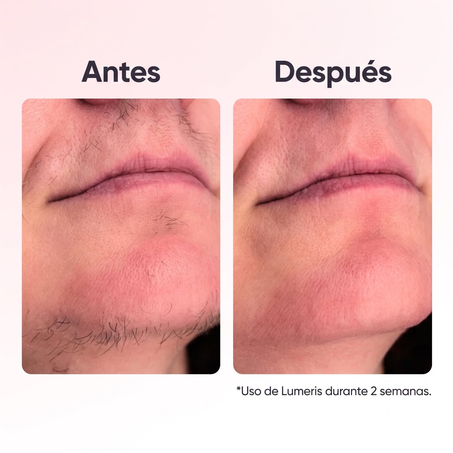 Lumeris® | Depilación láser permanente desde casa