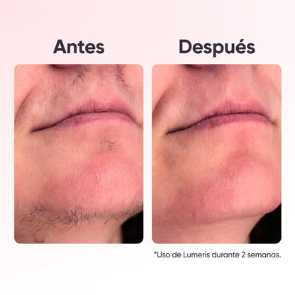 Lumeris® | Depilación láser permanente desde casa