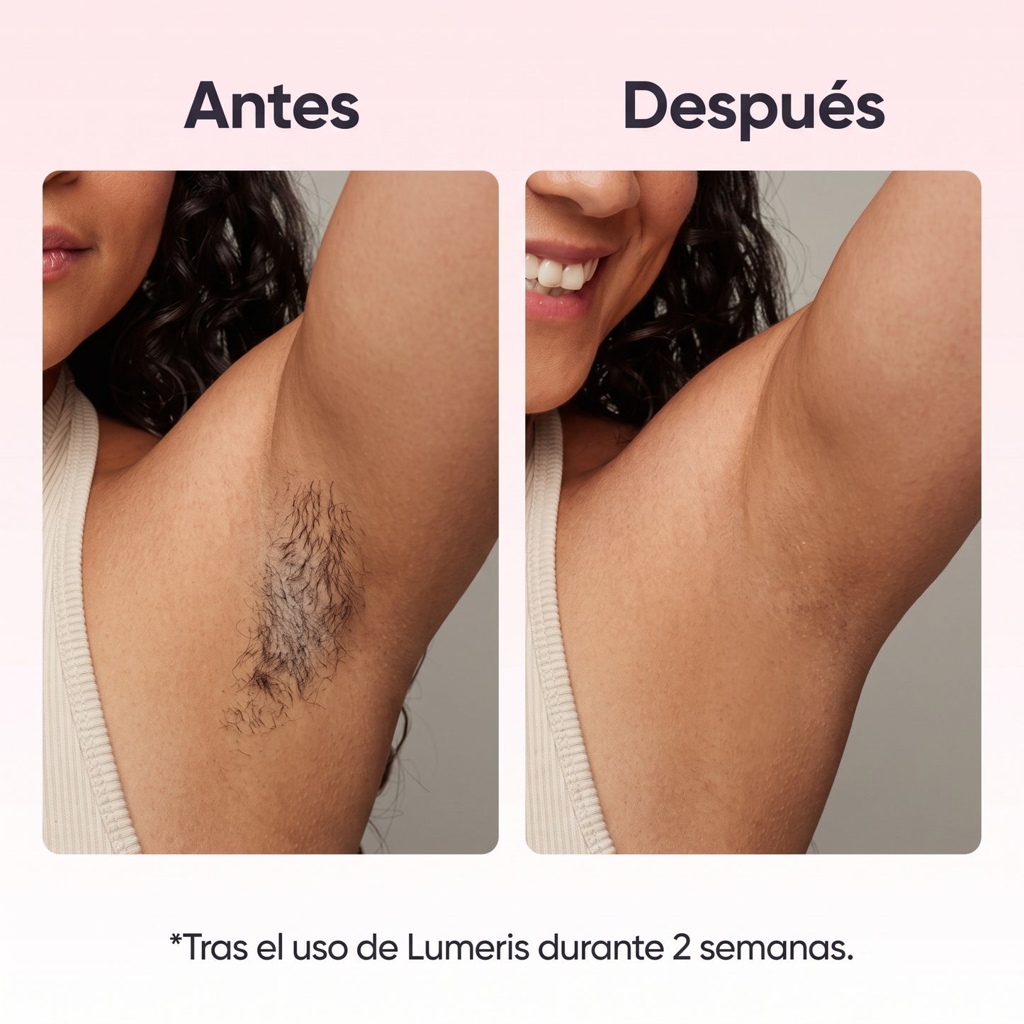 Lumeris® | Depilación láser permanente desde casa