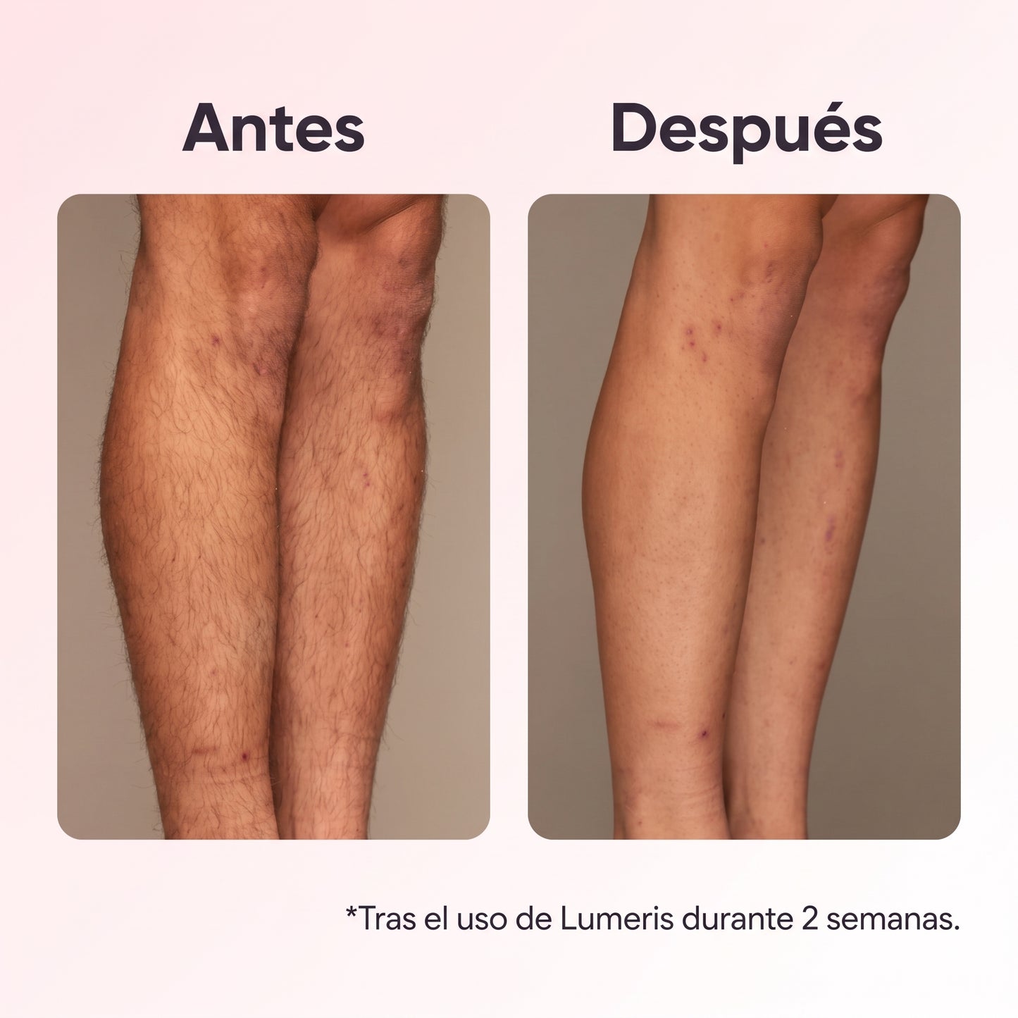 Lumeris® | Depilación láser permanente desde casa