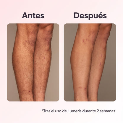 Lumeris® | Depilación láser permanente desde casa