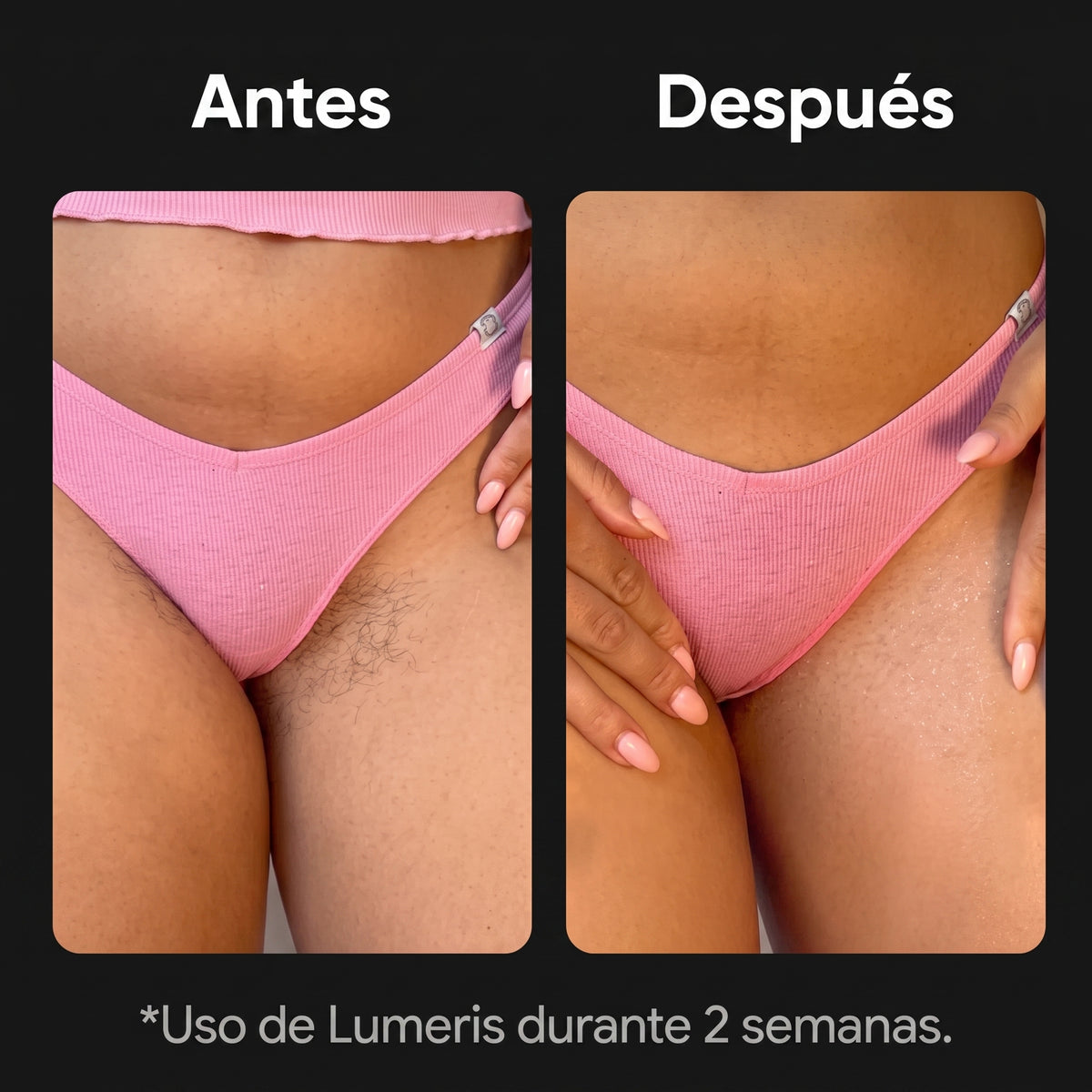 Lumeris® | Depilación láser permanente desde casa